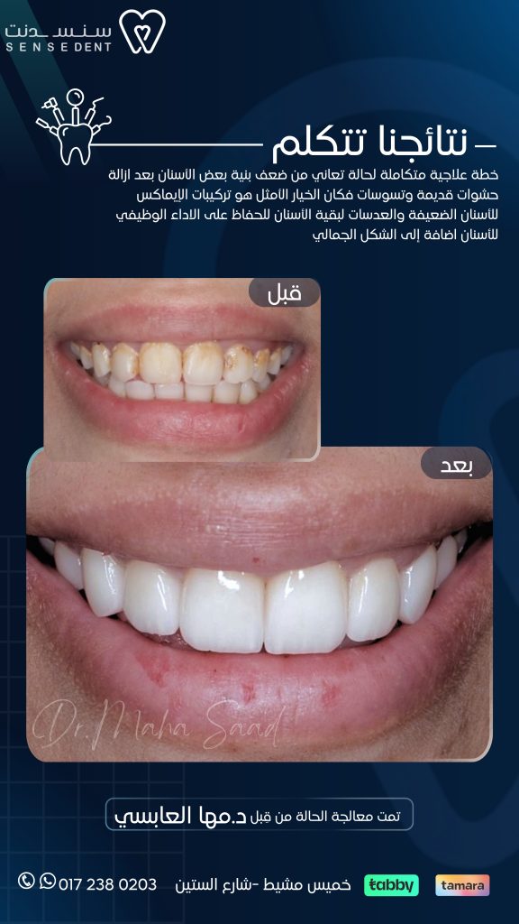 تركيبات الايماكس