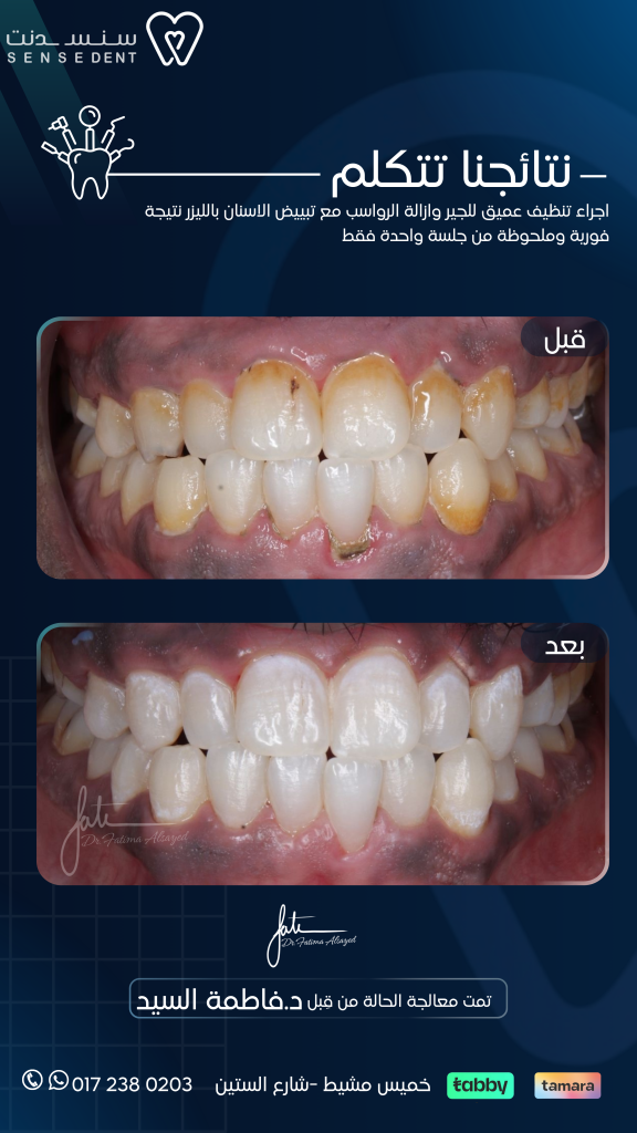 تنظيف الاسنان بالليزر